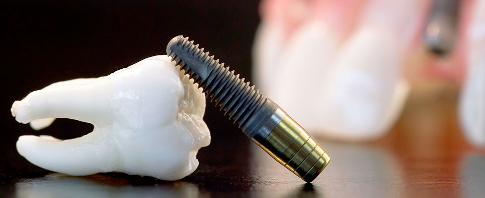 Dental implant